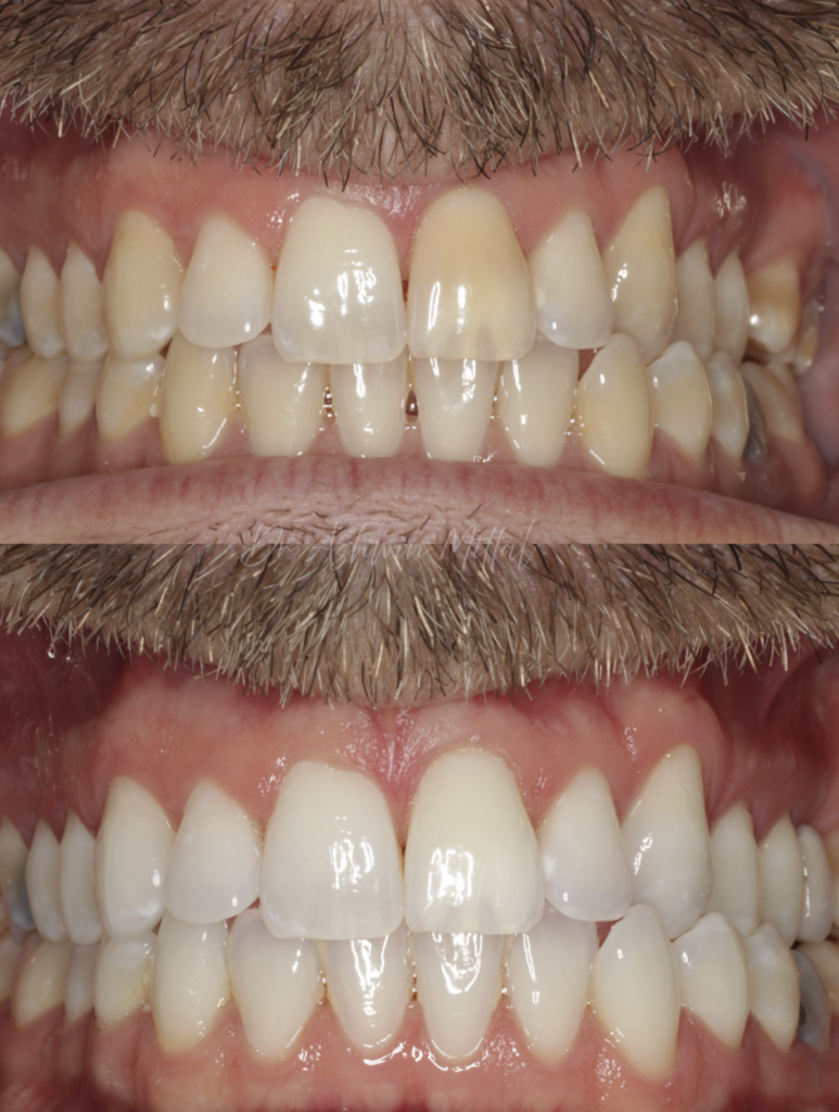 Teeth whitening in uckfield