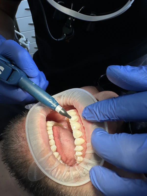 composite bonding